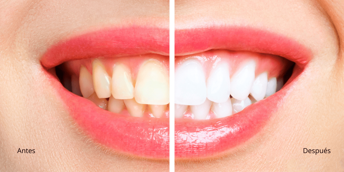 blanqueamiento dental antes y después