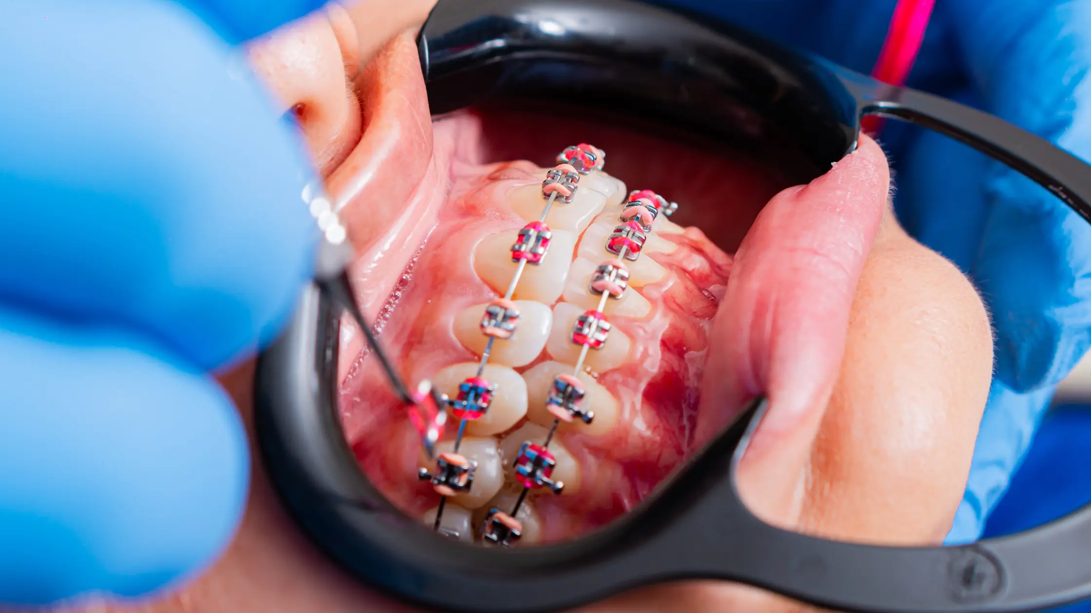 Dientes torcidos adultos
